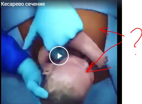 Кесарево сечение
