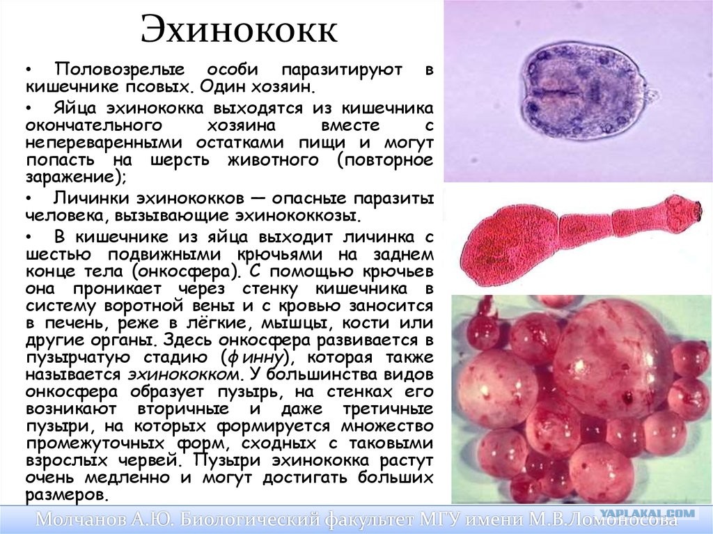 альвеококкоз симптомы