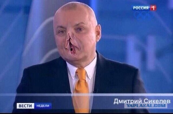 Телеведущий Дмитрий Киселев объяснил разбитое в Крыму лицо сменой имиджа, которая «отражает его позицию