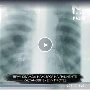 На Урале онкобольной год проходил с протезом, которого нет