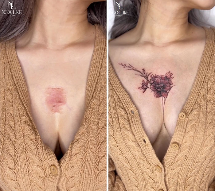 Виды рубцов и выбор татуировки