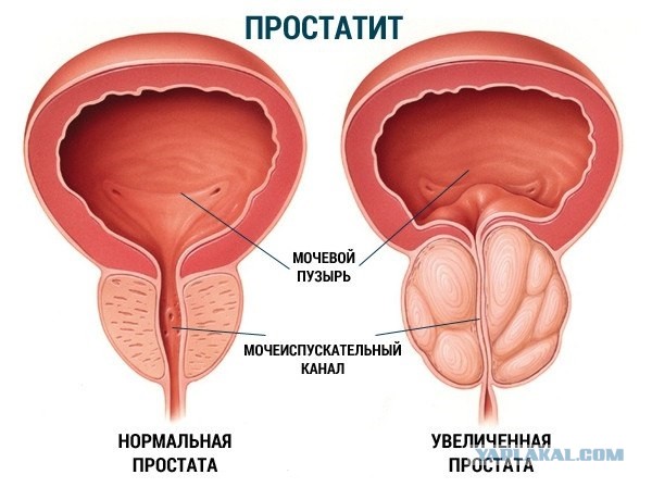 Простата хуже воровства