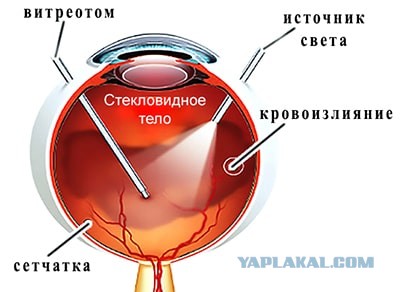 Что ищут офтальмологи у пациентов с плавающими помутнениями?