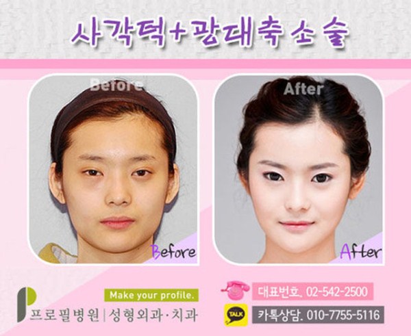Южные корейцы до и после пластической операции