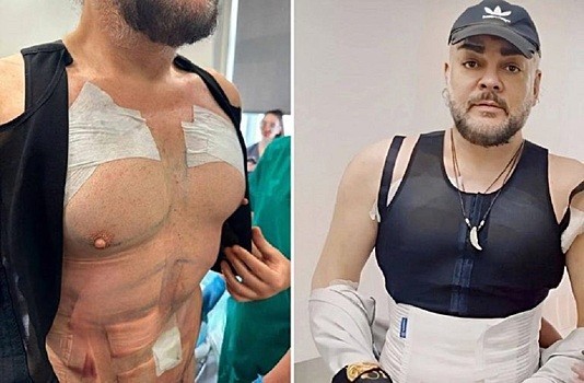 Накладные плечи: в Москве мужчины стали массово увеличивать мышцы в клиниках красоты