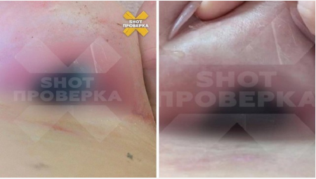 У 29-летней россиянки загноилась и порвалась грудь после установки имплантов: операцию проводил внештатный сотрудник клиники