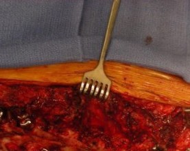 Сильная девушка до, во время и после операции на позвоночнике