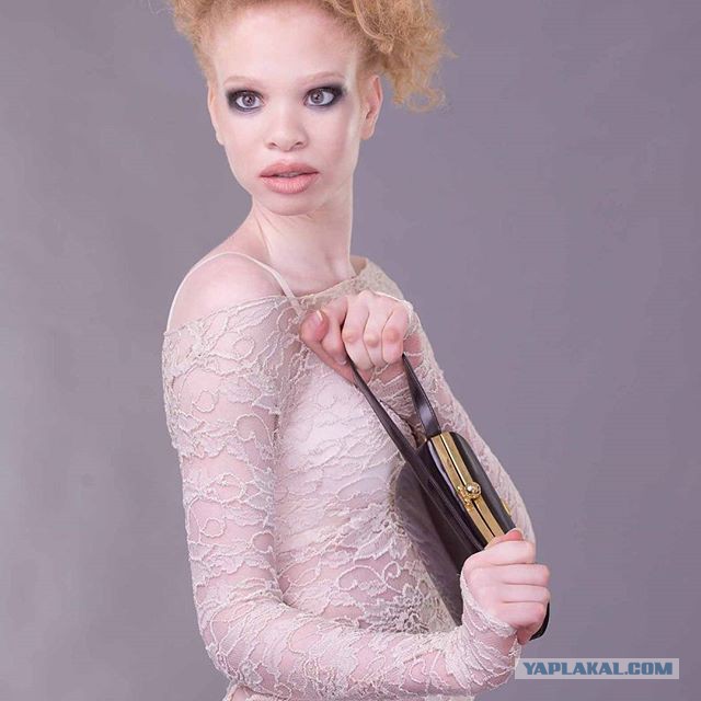 Подвергавшаяся издевательствам из-за альбинизма африканка стала моделью