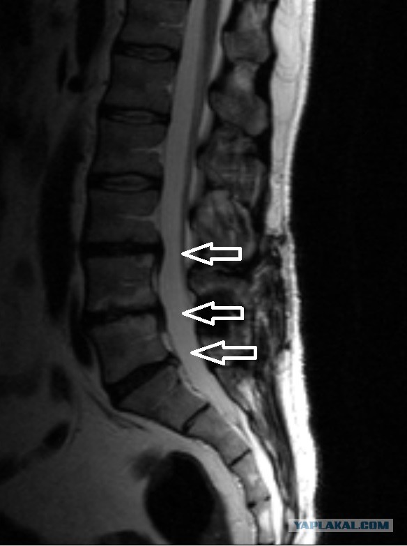 Сильная девушка до, во время и после операции на позвоночнике