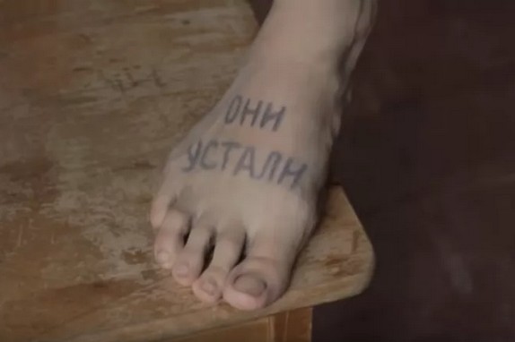 Врачи спасли мужчину с химическим ожогом стоп — он провёл более суток в обуви, пропитанной раствором для обработки полов