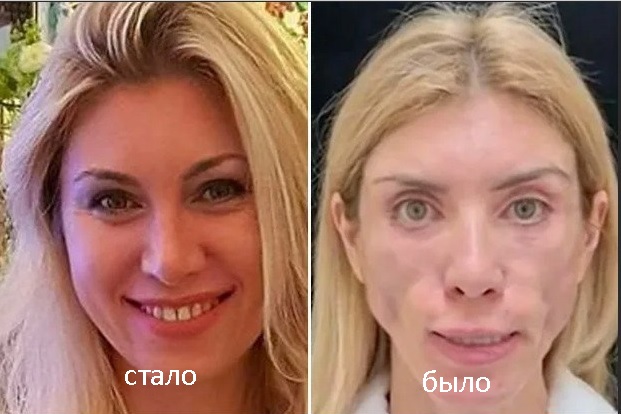 Суд взыскал 3 млн рублей в пользу модели из Сочи, которая больше не может улыбаться, моргать и спать с закрытыми глазами