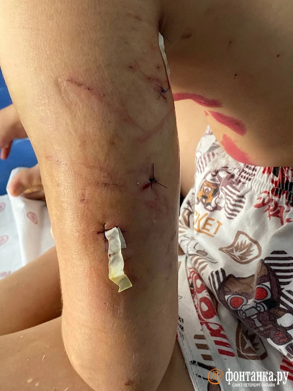 Три собаки «целовательной породы» напали под Петербургом на 13-летнюю велосипедистку