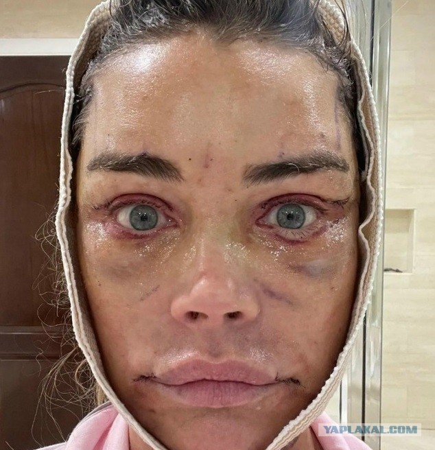 Дениз Ричардс сделала круговую подтяжку лица и шеи.