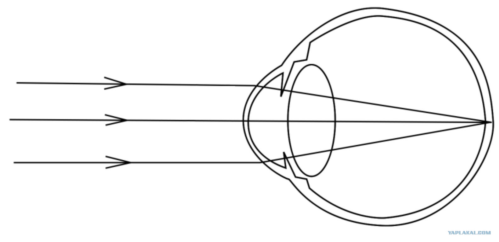 Нормальный глаз схема. Эмметропия миопия гиперметропия. Схема глаза эмметропии. Миопия схема преломления лучей. Близорукость ход лучей в глазе.