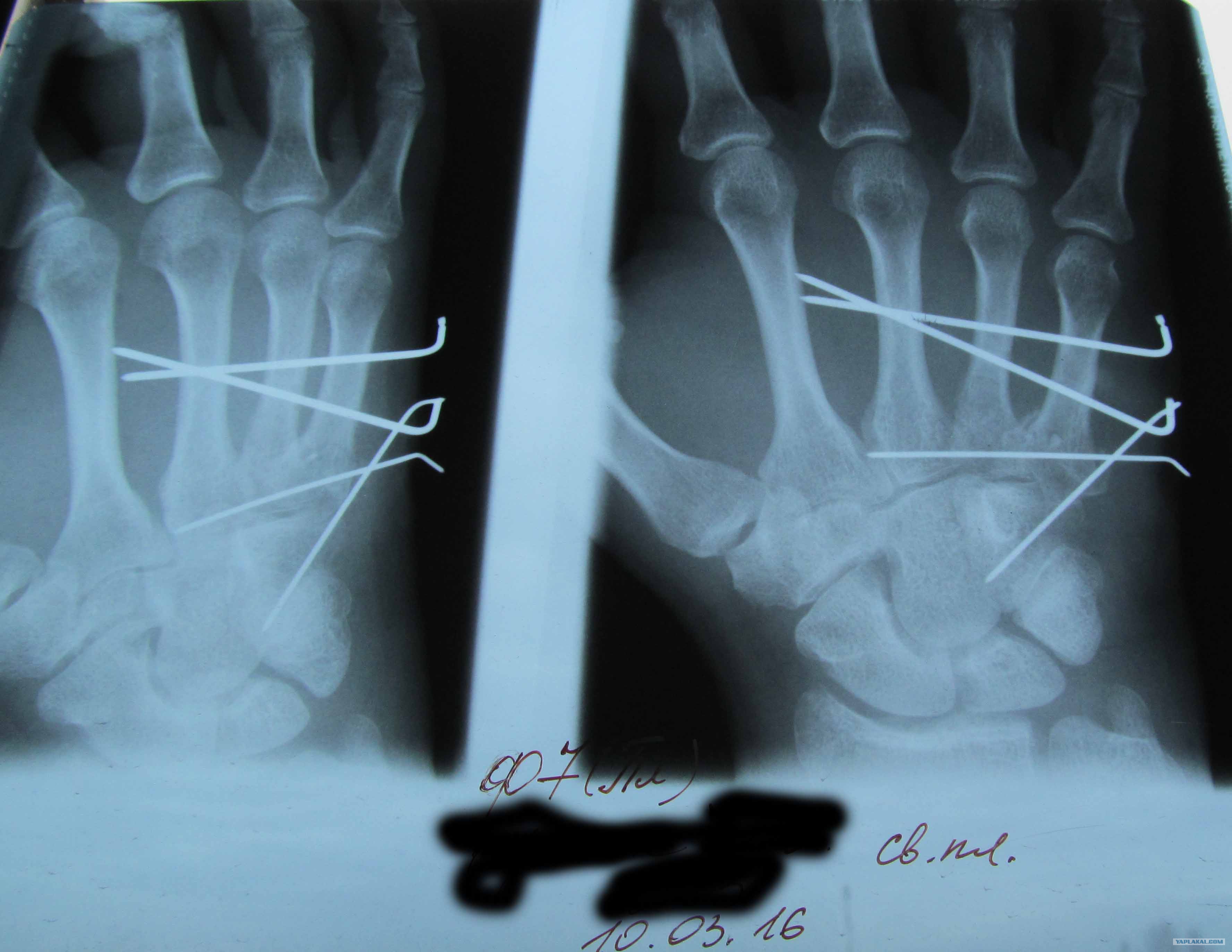 Поставить на 4 кости. Субкапитальный перелом 5 пястной кости. Поперечный перелом пястной кости. Перелом пястной кости 4 пальца. Перелом пястной кости 5 пальца.