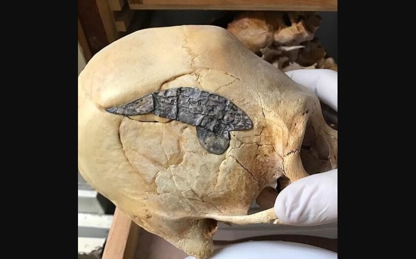 Череп древнего воина с металлической пластиной (Фото)