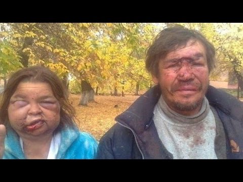 «Раздувало лицо, голову». Девушка попала в реанимацию после уколов у косметолога-самоучки