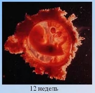 Московская пара решила вместо аборта рожать смертельно больного ребёнка.