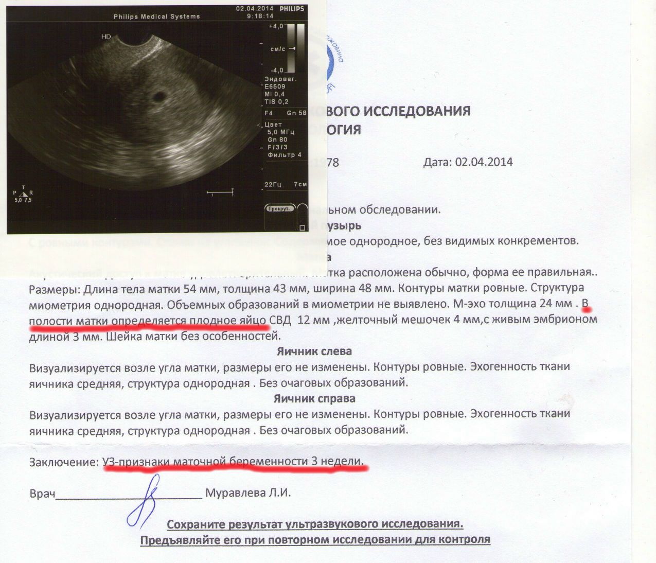 Размер полости матки. Анэмбриония по УЗИ заключение. Анэмбриония на УЗИ 6 недель. Желточный мешочек визуализируется 3 мм. КТР 7 мм желточный мешок 5 мм.