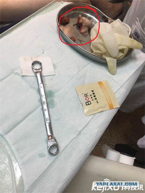 Стоматологи освободили пенис мужчины застрявший в гаечном ключе