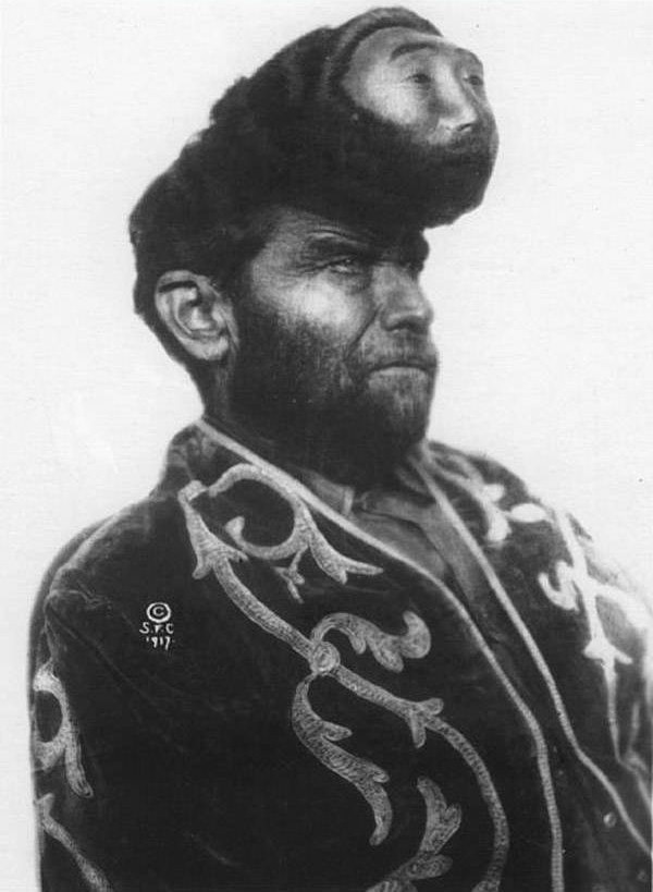 Паразитический краниопаг