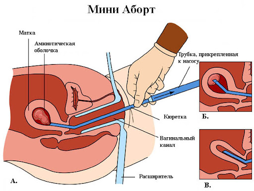 А што вы думаете о мужском аборте?
