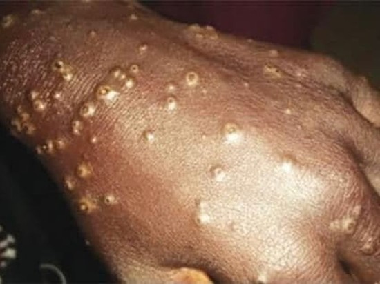 Вспышка неизвестной болезни в Сенегале. Её подхватило уже более 170 человек, их кожа покрылась волдырями, начался сильный зуд