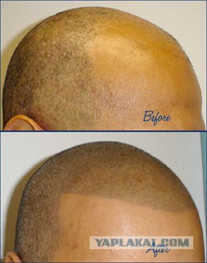 Девайс для лысеющих...