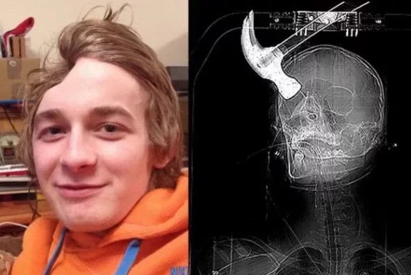 Как выглядит человек без мозгов Муж случайно выстрелил в свою молодую жену и оставил ее без лица.Спустя 5 лет же