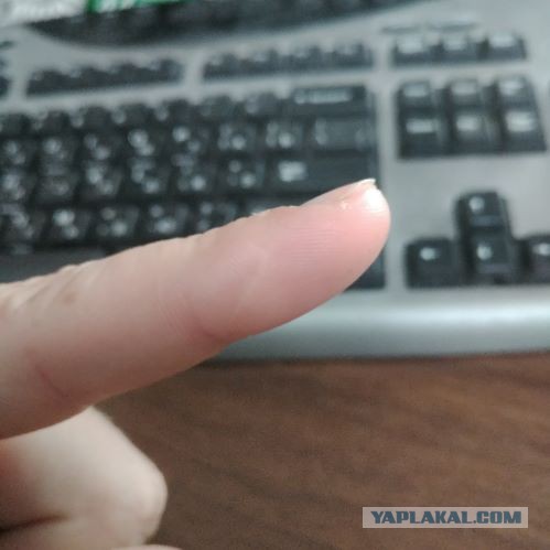 Шрамы на пальце - есть у всех? У меня даже два!