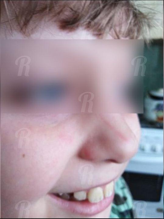"Жри! Жри быстрее!" — смоленская учительница расцарапала ребенку лицо из-за котлеты