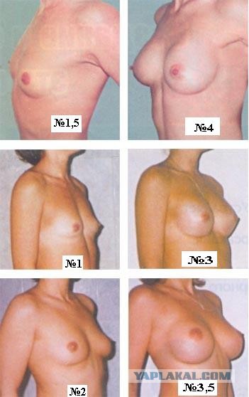 Так какой размер?1-й, 2-й или 6-й?, О горестях дам ( о сиськах)