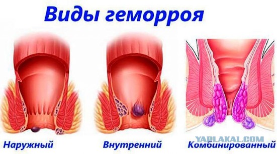 Производственная травма