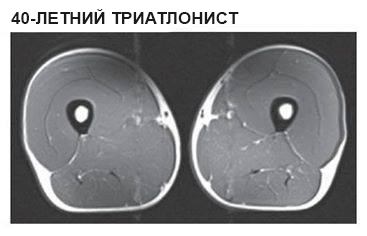 Снимки МРТ мышц ног, наглядно демонстрирующие, почему стоит заниматься спортом