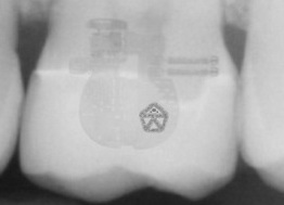В США в зубе бывшего сотрудника ФБР обнаружен инопланетный чип