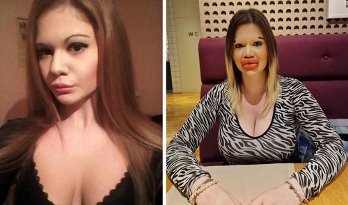 Губошлепка с самыми огромными губами захотела их еще больше увеличить