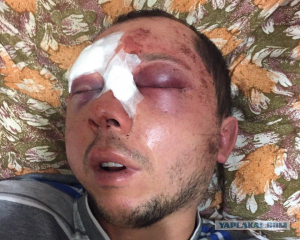 Операция по исправлению кривой носовой перегородки