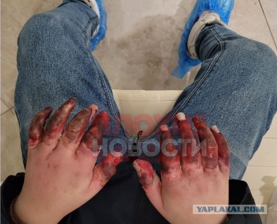 7-летнему мальчику пришлось ампутировать пальцы на руках после издевательств со стороны отчима в Москве