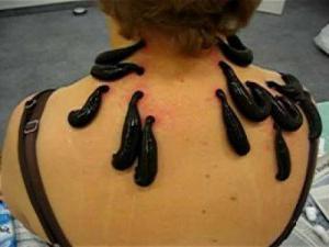 Герудотерапия