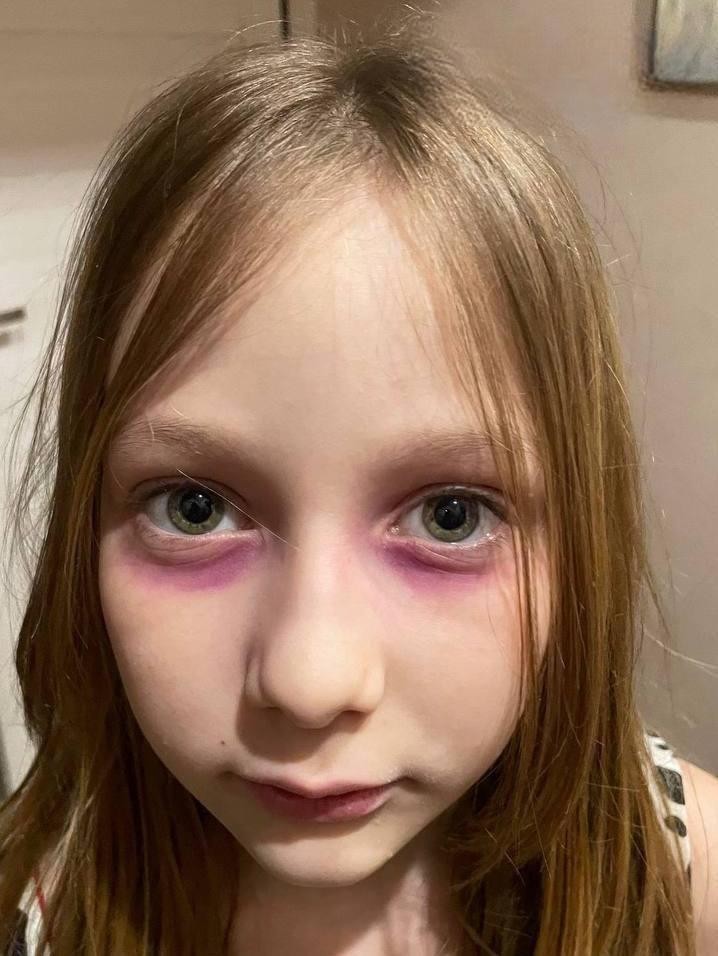 Мать года неделю лечила дочь от «редкой болезни» с розовыми кругами под глазами — в итоге оказалось, что всё это… фломастер