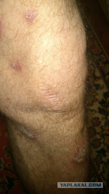 Болит колено