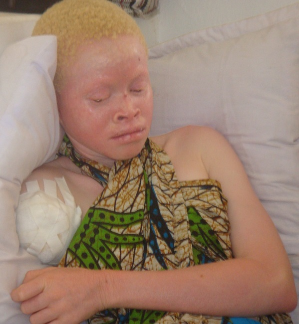 Страшная доля альбиносов Танзании