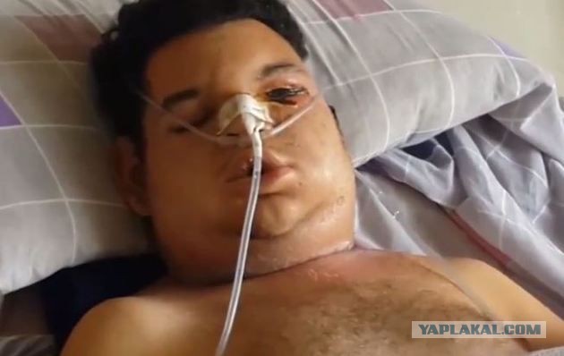 Жертва самого ядовитого в мире паука 18+