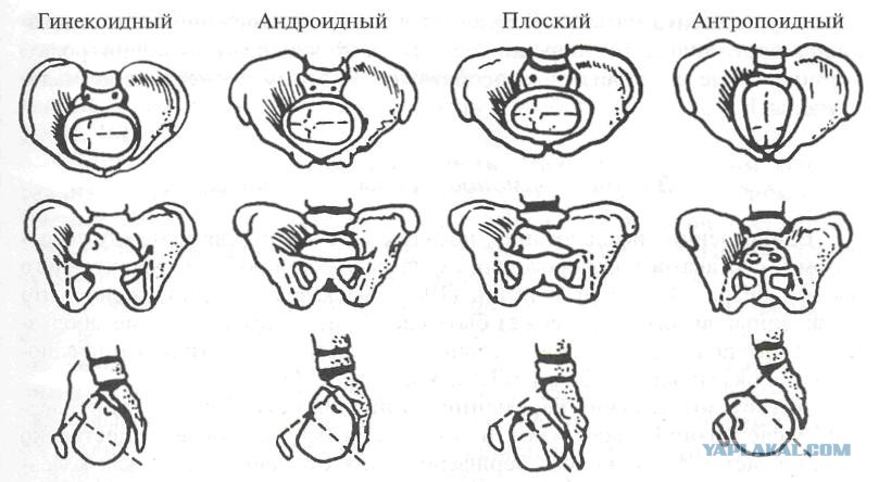 Редко встречающиеся формы узкого таза. Анатомически нормальный таз. Типы тазов. Типы тазов. Виды тазов.
