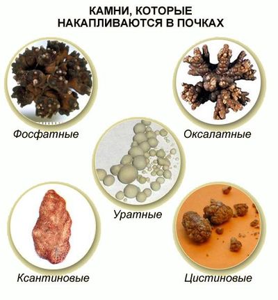 Как кузнец себе литотомию сделал