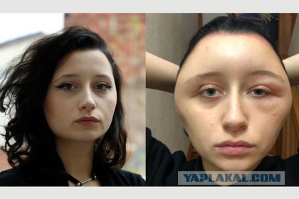 Она хотела пухлые губы, но все как-то пошло не по плану