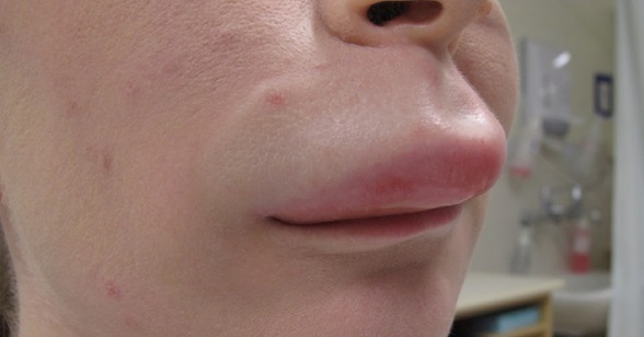 Эффект «заячьих губок»: результатами новой авторской методики поделилась косметолог-уродолог в сети