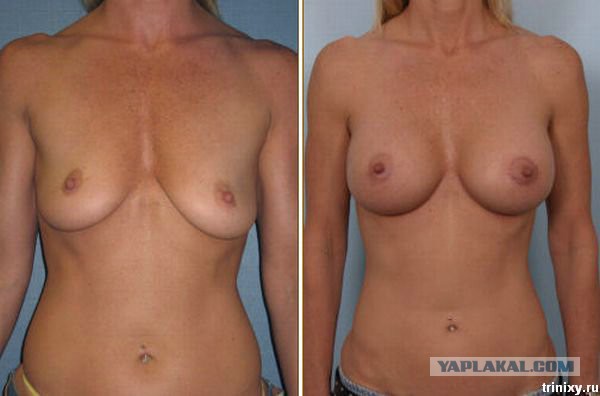 Некоторым девушкам силиконовая грудь просто