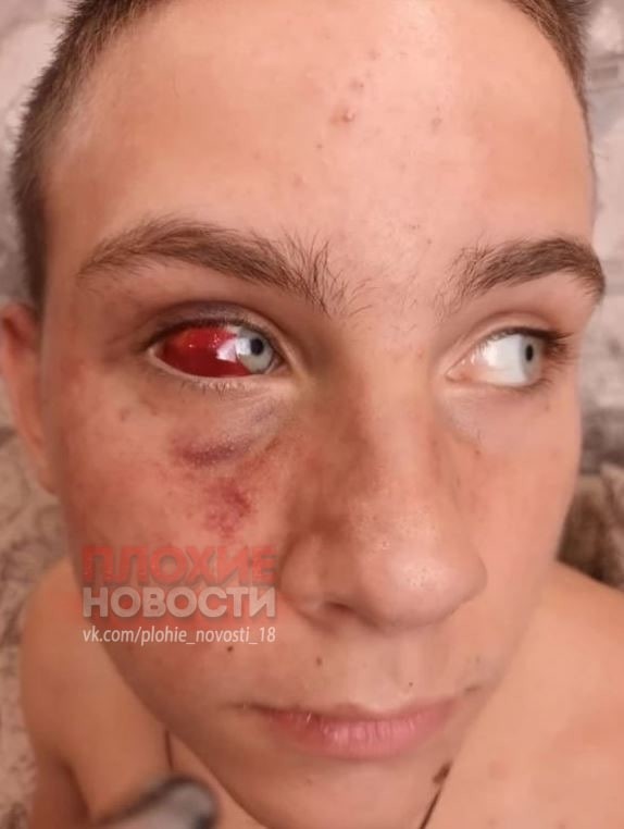 "Я уже был готов умереть": в Волгограде полицейские избили 14-летнего парня, ошибочно приняв за "закладчика"