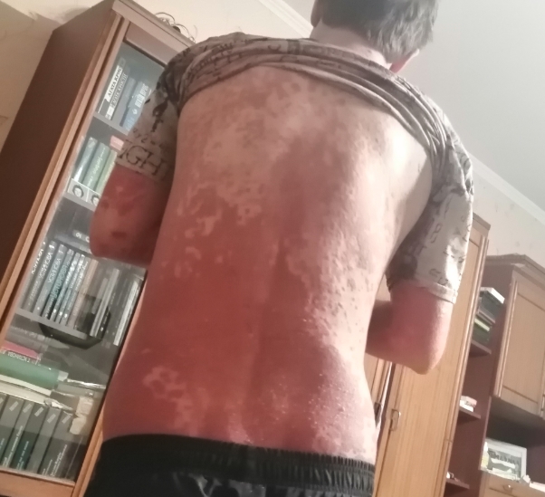 В Москве врачи вылечили мужчину с полным поражением кожи псориазом
